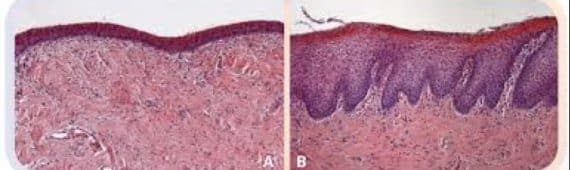 Coupe histologique de la muqueuse vaginale, avant (A) et 1 mois après (B) traitement par laser CO2, on note l’épaississement notable de la muqueuse en post-traitement.